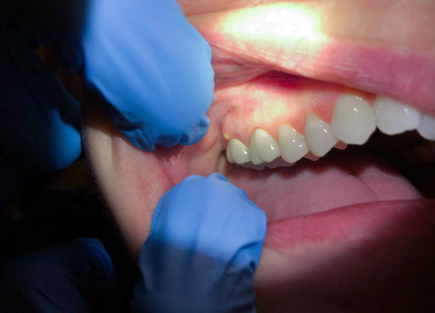 Best Emergency Care for Gum Disease in Meridian, PA
